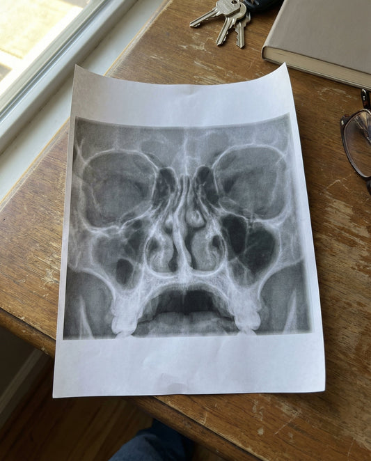 Ronflement Occasionnel : Causes, Solutions et Prévention Efficace